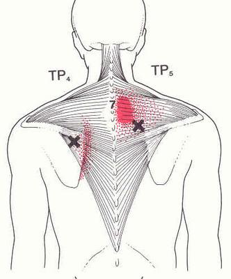 Triggerpointtherapie