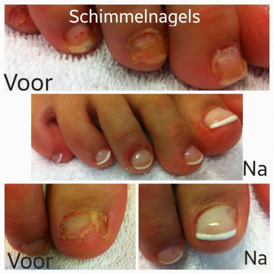 Last van kalknagels? Laserbehandeling voor gezonde en heldere nagels