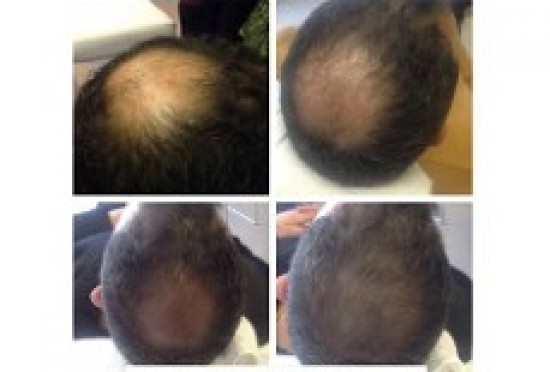 Haaruitval bestrijden met een voordelige haartransplantatie? — foto 2