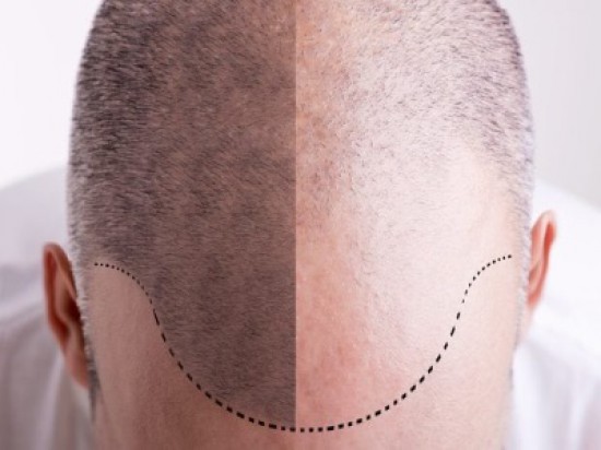 Haartransplantatie bij Dutch Clinic — foto 2