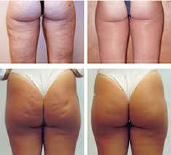 Vet verwijderen dmv lipo laser — foto 2