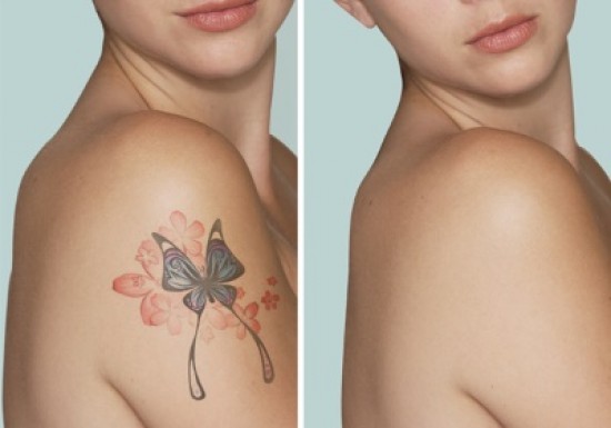 Laat uw tattoo weglaseren door de specialist van Nederland! — foto 3